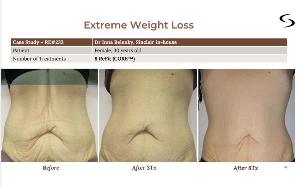 Sinclair V30 VForm RF before and after photos Sinclair V30 VForm ReFit Before and After photos during abdominal skin laxity post weight loss treatment phases.